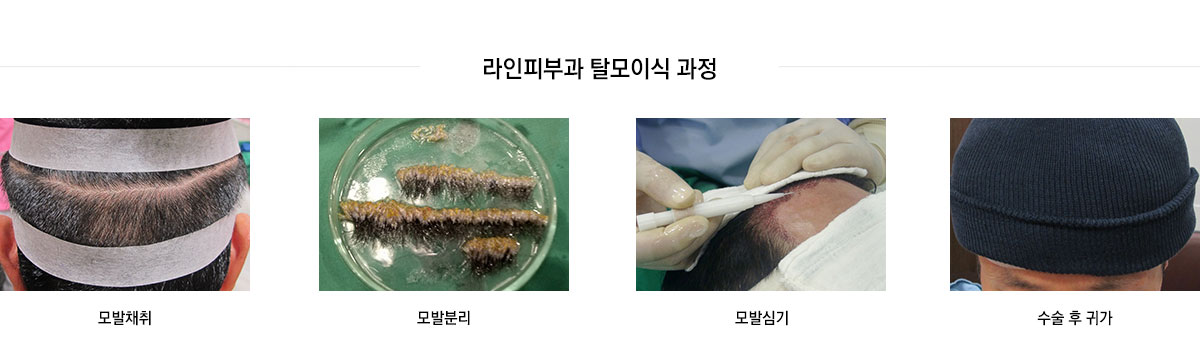 라인피부과 탈모이식 과정